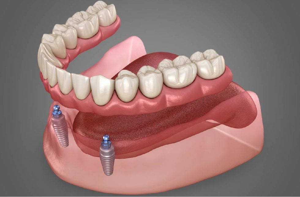 Portf Lio Protocolos Sobre Implante Kion Dental