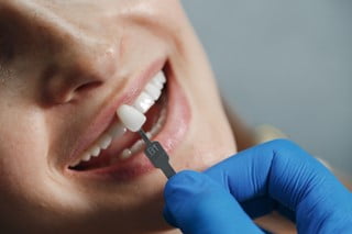 FACETA DENTÁRIA | COMO SÃO PRODUZIDAS EM LABORATÓRIO