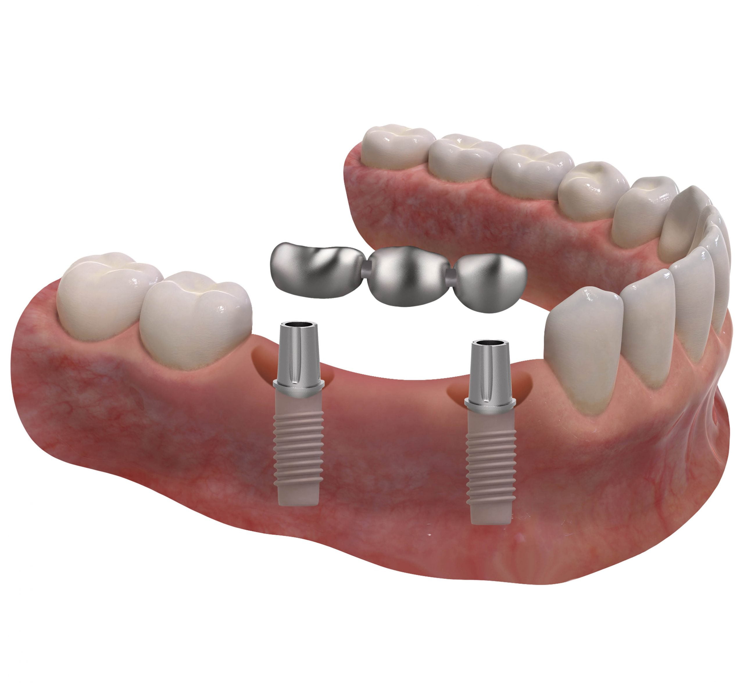 Prótese parcial fixa cimentada - Kion Dental